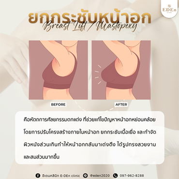 เสริมหน้าอก ที่ไหนดี ราคา